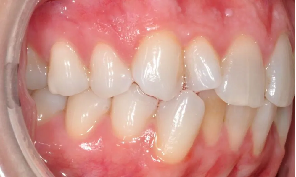 Clinical photo from Becca's surgically accelerated orthodontics case